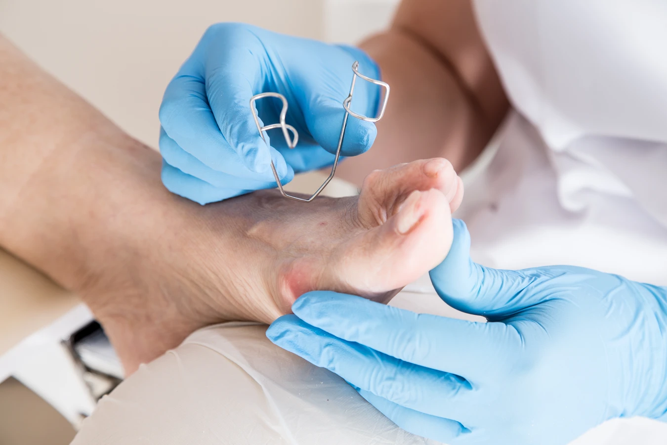  Jak podolog leczy grzybice paznokci?